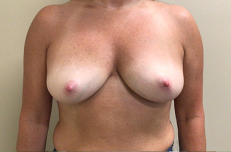 Breasts after breast implant removal, front view — Dr. Rudderman, Atlanta.