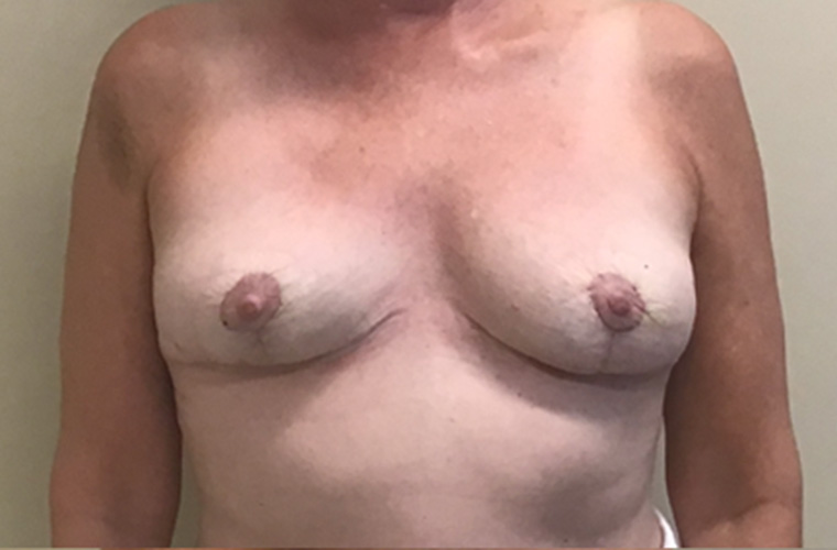 Breasts after breast implant removal, front view — Dr. Rudderman, Atlanta.