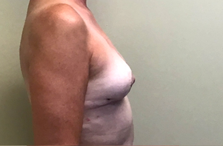 Breasts after breast implant removal, side profile view — Dr. Rudderman, Atlanta.