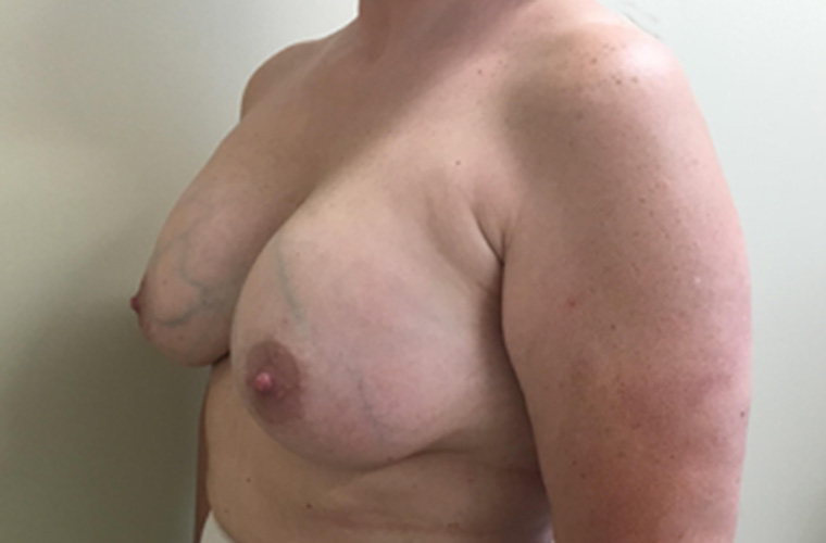 Breasts after breast implant removal, three-quarter view — Dr. Rudderman, Atlanta.