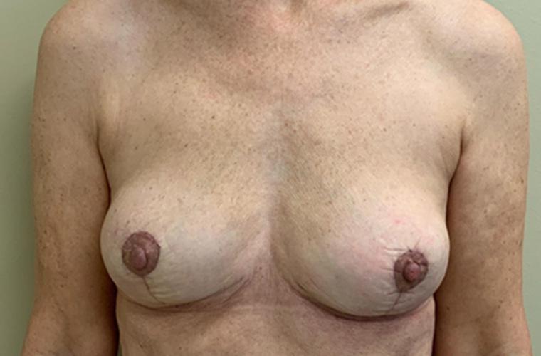 Breasts after breast implant removal, front view — Dr. Rudderman, Atlanta.