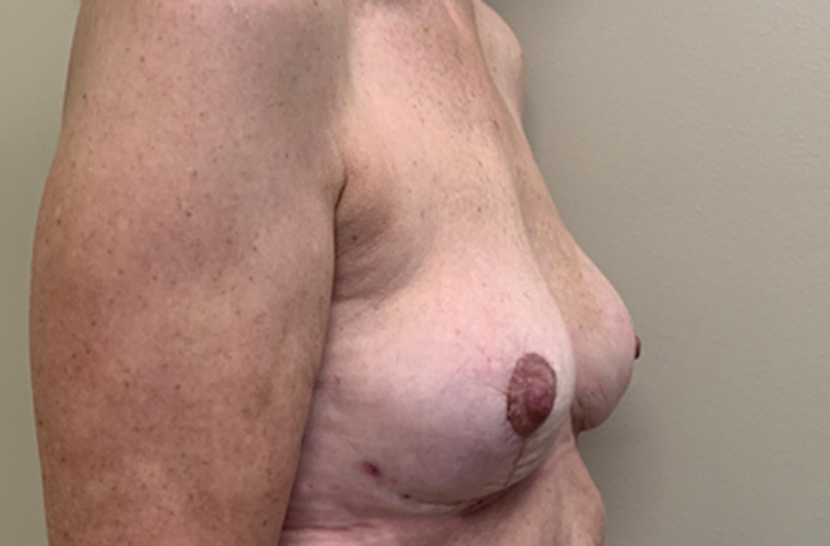 Breasts after breast implant removal, side profile view — Dr. Rudderman, Atlanta.