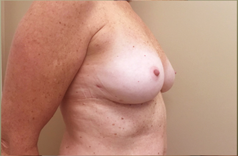 Breasts after breast implant removal, three-quarter view — Dr. Rudderman, Atlanta.