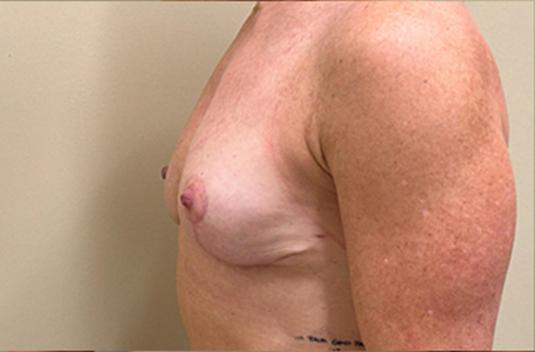 Breasts after breast implant removal, side profile view — Dr. Rudderman, Atlanta.