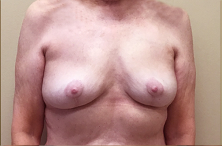 Breasts after breast implant removal, front view — Dr. Rudderman, Atlanta.