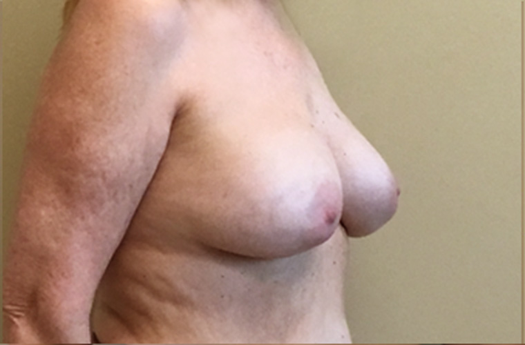 Breasts before breast implant removal, three-quarter view — Dr. Rudderman, Atlanta.