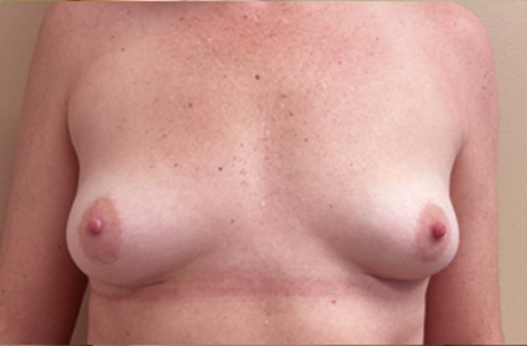 Breasts after breast implant removal, front view — Dr. Rudderman, Atlanta.