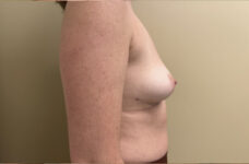 Breasts after breast implant removal, side profile view — Dr. Rudderman, Atlanta.