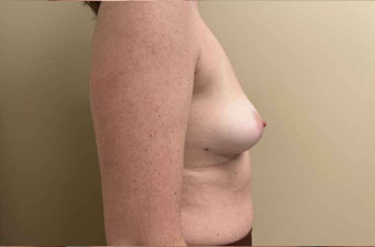 Breasts after breast implant removal, side profile view — Dr. Rudderman, Atlanta.