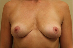 Breasts after breast implant removal, front view — Dr. Rudderman, Atlanta.