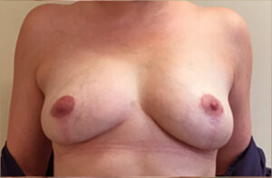 Breasts after breast implant removal, front view — Dr. Rudderman, Atlanta.