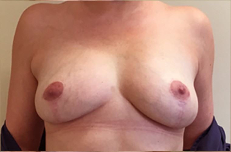 Breasts after breast implant removal, front view — Dr. Rudderman, Atlanta.