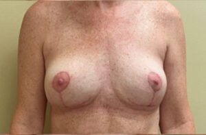Breasts after breast implant removal, front view — Dr. Rudderman, Atlanta.