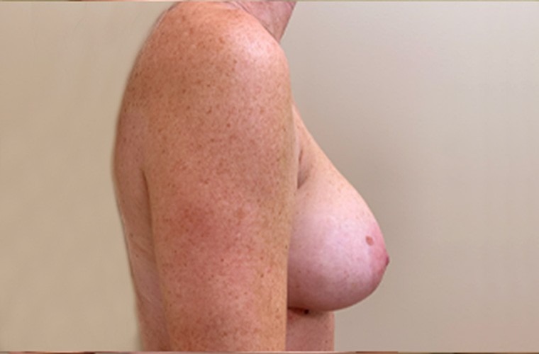 Breasts before breast implant removal, side profile view — Dr. Rudderman, Atlanta.