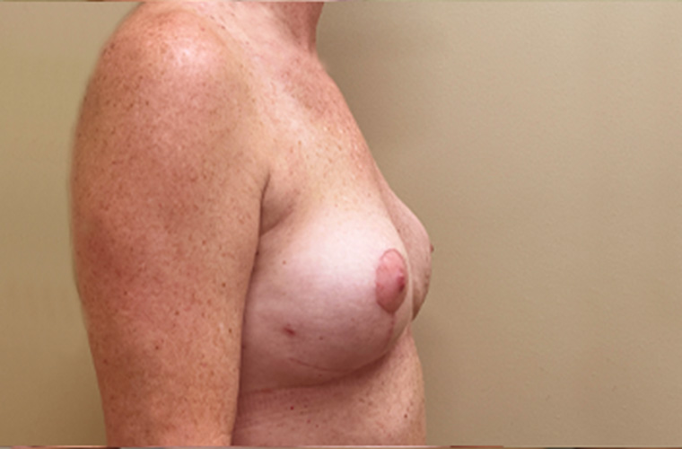 Breasts after breast implant removal, side profile view — Dr. Rudderman, Atlanta.