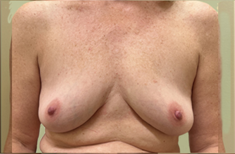 Breasts after breast implant removal, front view — Dr. Rudderman, Atlanta.