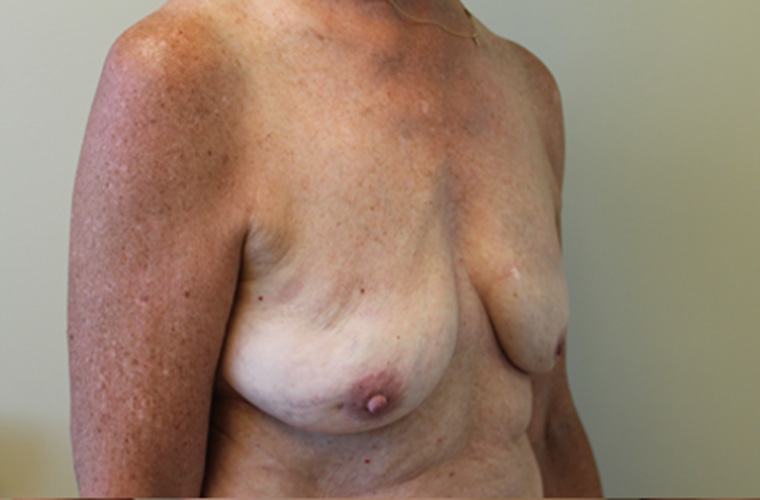 Breasts after breast implant removal, three-quarter view — Dr. Rudderman, Atlanta.