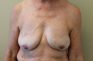 Breasts after breast implant removal, front view — Dr. Rudderman, Atlanta.