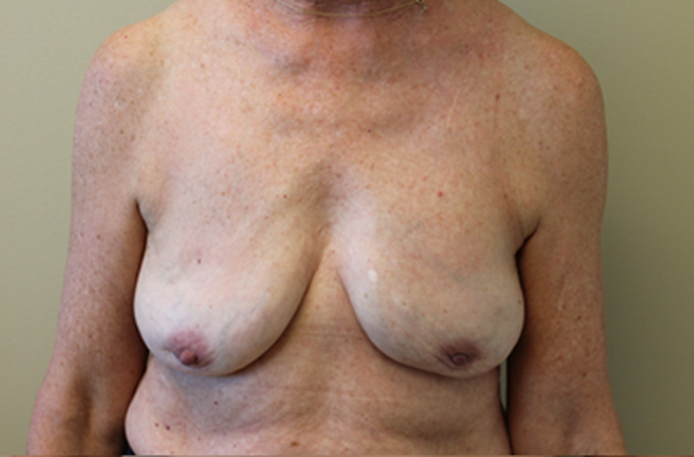 Breasts after breast implant removal, front view — Dr. Rudderman, Atlanta.