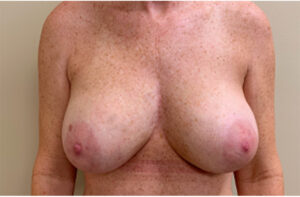 Breast implant removal patient photo, front view of the breasts — Dr. Rudderman, Atlanta.