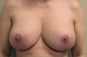 Breasts after breast lift, front view — Dr. Rudderman, Atlanta.