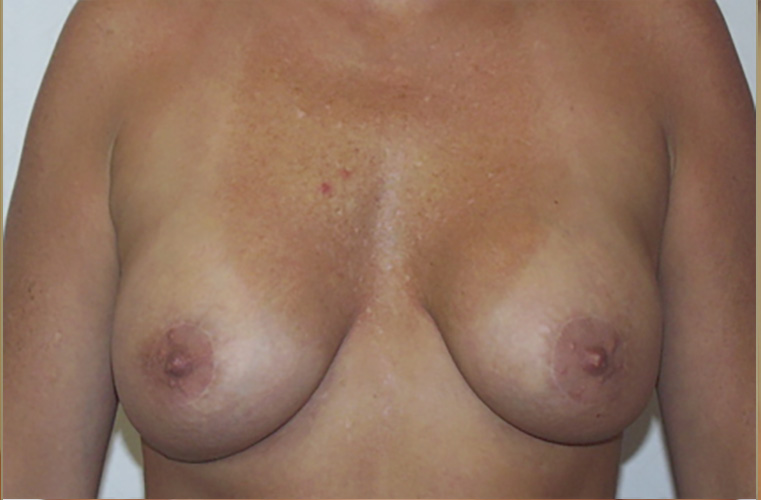 Breasts after breast lift, front view — Dr. Rudderman, Atlanta.