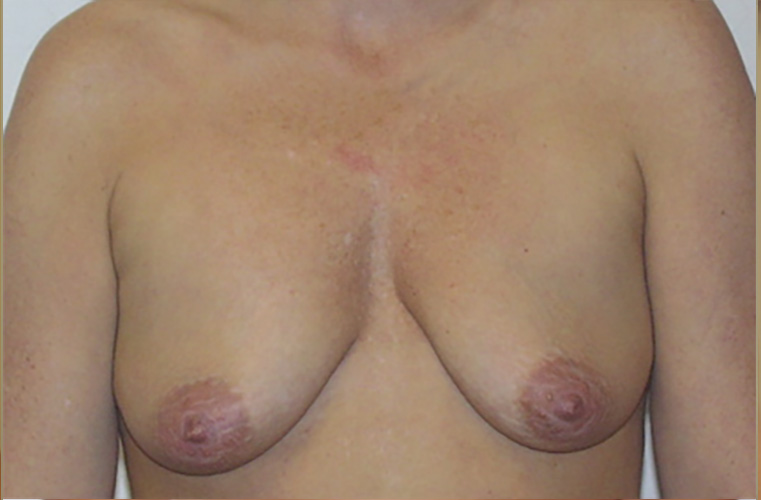 Breasts before breast lift, front view — Dr. Rudderman, Atlanta.