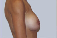 Breasts after breast lift, side profile view — Dr. Rudderman, Atlanta.