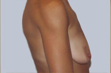 Breasts before breast lift, side profile view — Dr. Rudderman, Atlanta.