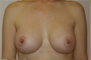 Breasts after breast lift, front view — Dr. Rudderman, Atlanta.