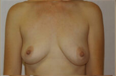 Breasts before breast lift, front view — Dr. Rudderman, Atlanta.