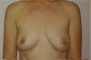 Breasts before breast lift, front view — Dr. Rudderman, Atlanta.