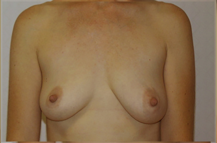 Breasts before breast lift, front view — Dr. Rudderman, Atlanta.
