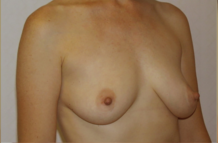 Breasts before breast lift, three-quarter view — Dr. Rudderman, Atlanta.
