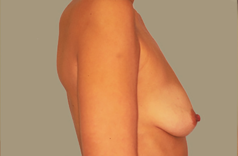 Breasts before breast lift, side profile view — Dr. Rudderman, Atlanta.