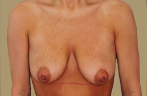 Breasts before breast lift, front view — Dr. Rudderman, Atlanta.