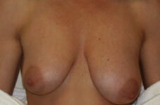 Breasts before breast lift, front view — Dr. Rudderman, Atlanta.