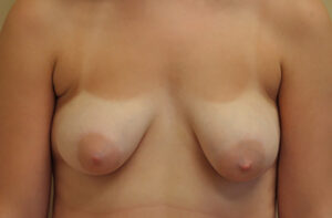 Breasts before breast lift, front view — Dr. Rudderman, Atlanta.