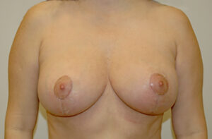 Breasts after breast lift, front view — Dr. Rudderman, Atlanta.