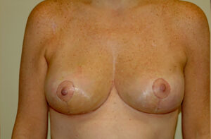 Breasts after breast lift, front view — Dr. Rudderman, Atlanta.