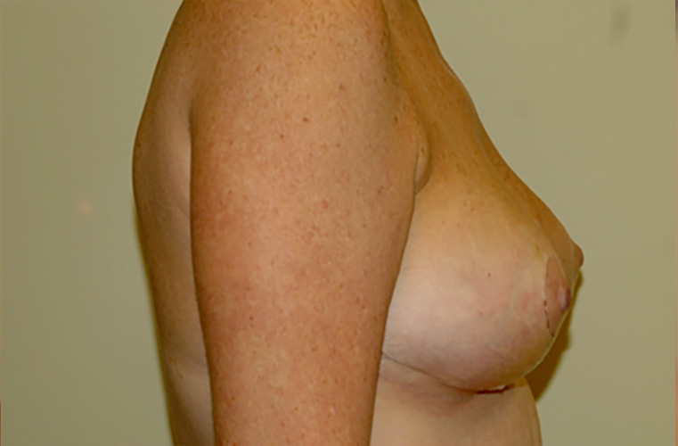 Breasts after breast lift, side profile view — Dr. Rudderman, Atlanta.