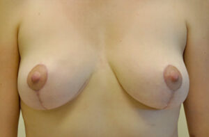 Breasts after breast lift, front view — Dr. Rudderman, Atlanta.