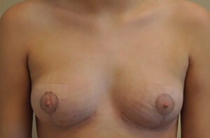 Breasts after breast lift, front view — Dr. Rudderman, Atlanta.