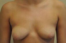 Breasts before breast lift, front view — Dr. Rudderman, Atlanta.