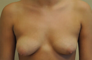 Breasts before breast lift, front view — Dr. Rudderman, Atlanta.