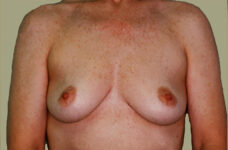Breasts before breast lift, front view — Dr. Rudderman, Atlanta.