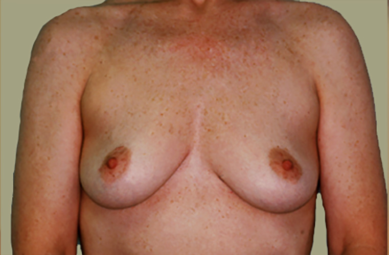 Breasts before breast lift, front view — Dr. Rudderman, Atlanta.