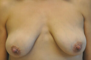 Breasts before breast lift, front view — Dr. Rudderman, Atlanta.