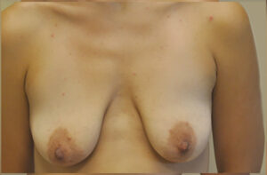 Breasts before breast lift, front view — Dr. Rudderman, Atlanta.