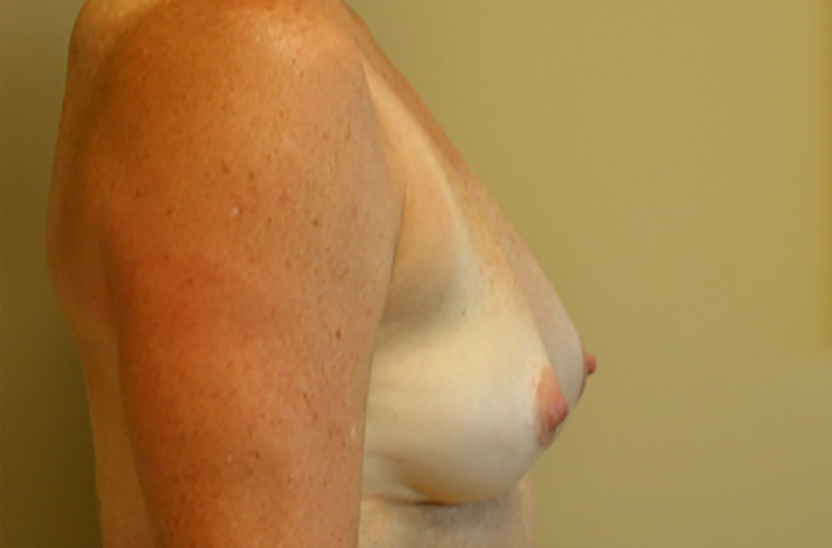 Breast revision patient photo, side profile view of the breasts — Dr. Rudderman, Atlanta.